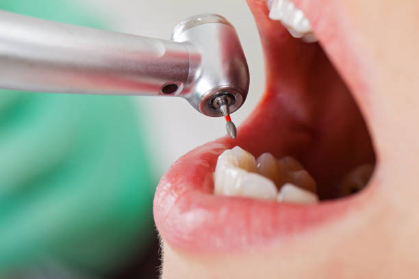 Best Emergency Wisdom Teeth Removal in White Sulphur Springs, MT